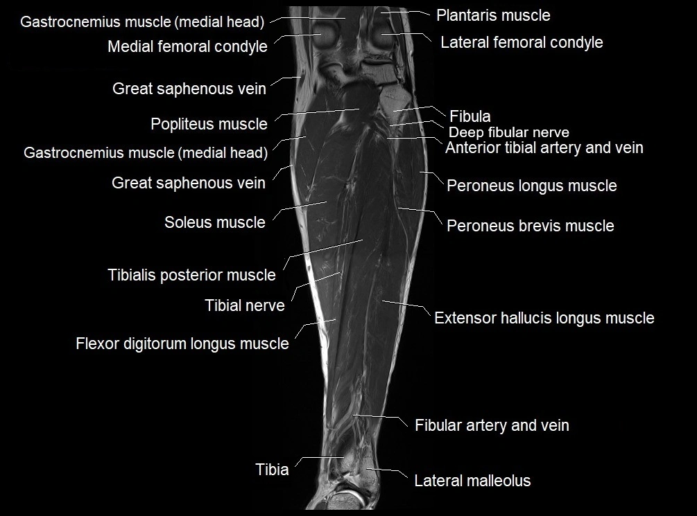 MRI 3T leg (tibia & fibula) labelled coronal cross sectional anatomy image 18.webp